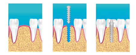 Implants dentaires saint-jean-de-luz